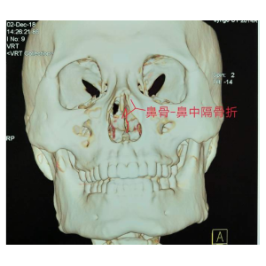 貴陽(yáng)銘仁耳鼻喉醫(yī)院提醒您：鼻子很脆弱，要好好保護(hù)