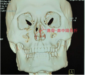 十歲小孩被書本砸破鼻子，(圖1)