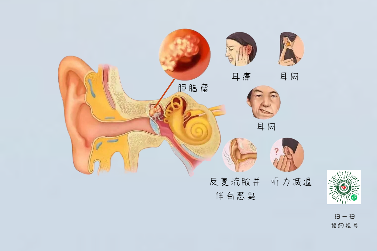 手術(shù)沒(méi)做干凈，術(shù)后3年顱內(nèi)竟發(fā)現(xiàn)巨大膽脂瘤！(圖6)