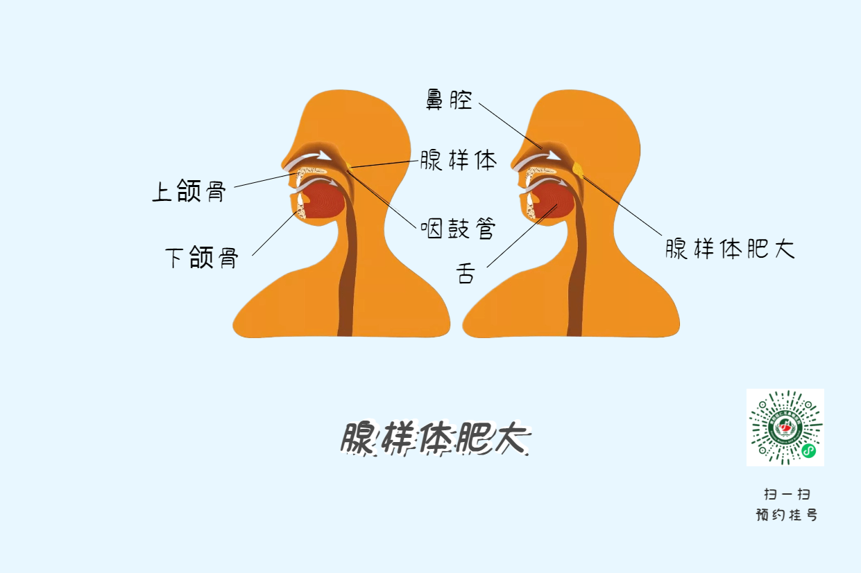 暑假來(lái)了，孩子腺樣體肥大到底切不切？(圖4)