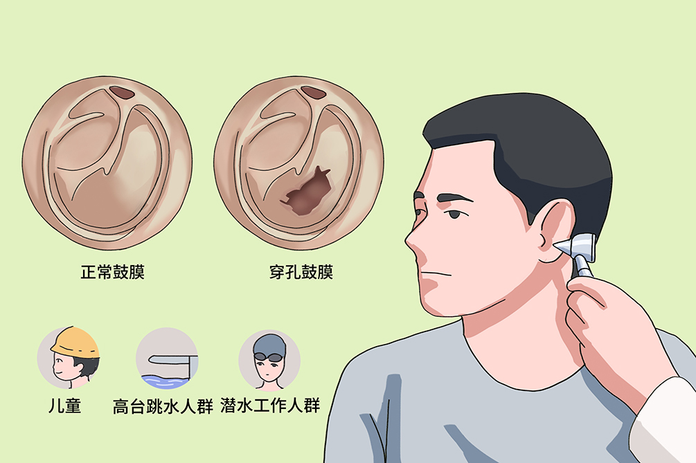 鼓膜穿孔不及時治療，會導致聽力下降，甚至引發(fā)顱內(nèi)感染？(圖3)