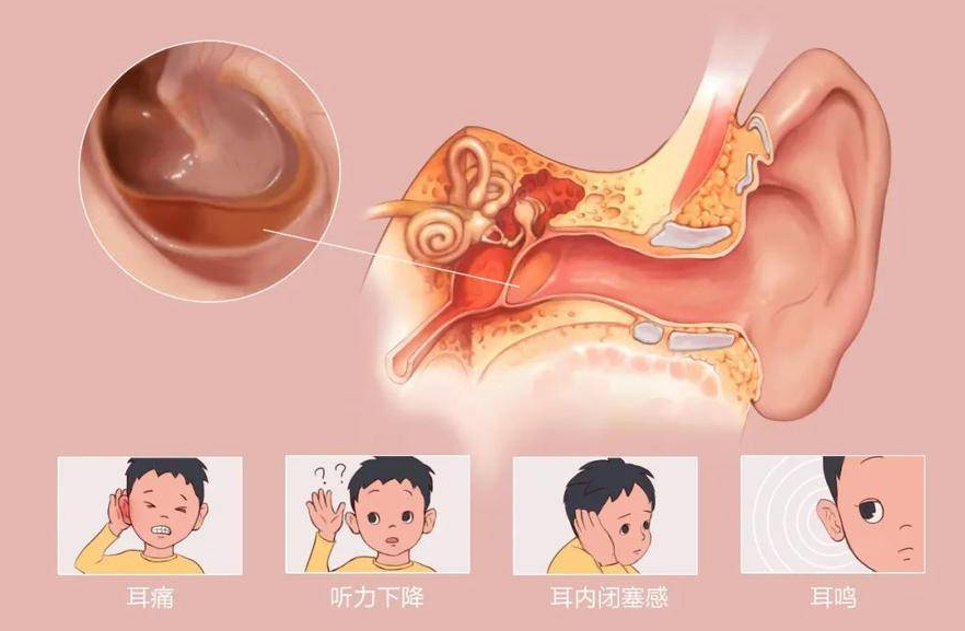  夏季游泳，謹(jǐn)防中耳炎“找麻煩”！(圖3)