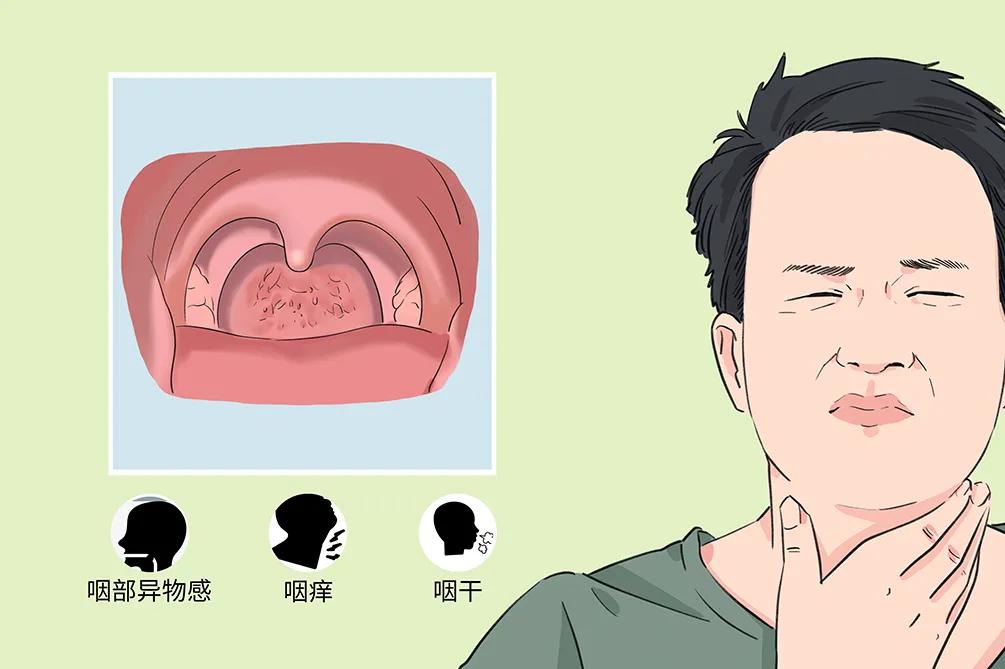 慢性咽炎的困擾：咽干、咽痛、咽部異物感(圖2)