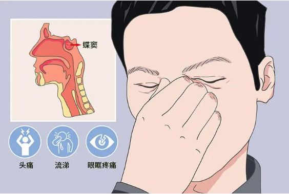 頭疼、眼痛雖小，卻可能是蝶竇炎發(fā)出的警告信號！(圖1)