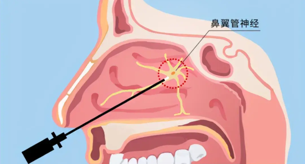 頭疼、眼痛雖小，卻可能是蝶竇炎發(fā)出的警告信號！(圖2)