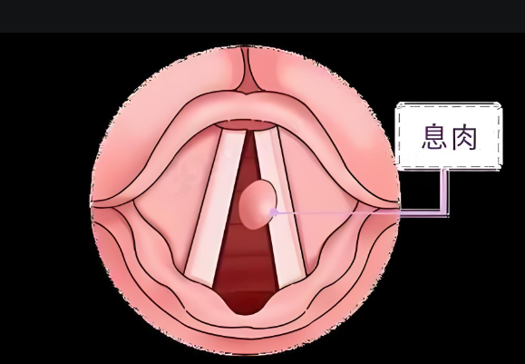 聲音嘶啞、嗓子難受，聲帶息肉不可小覷(圖1)