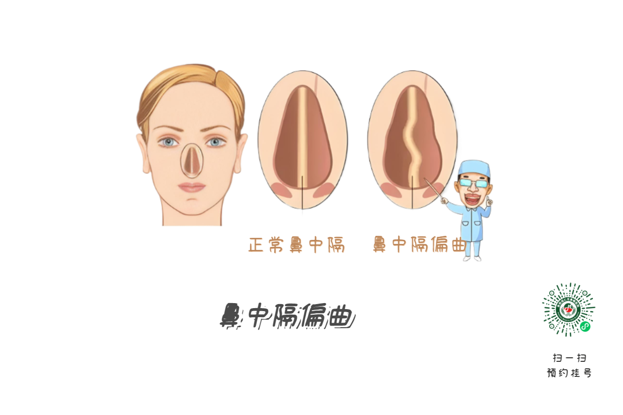 鼻塞、流涕、打噴嚏，是鼻炎引起的？注意可能是鼻中隔偏曲！(圖1)
