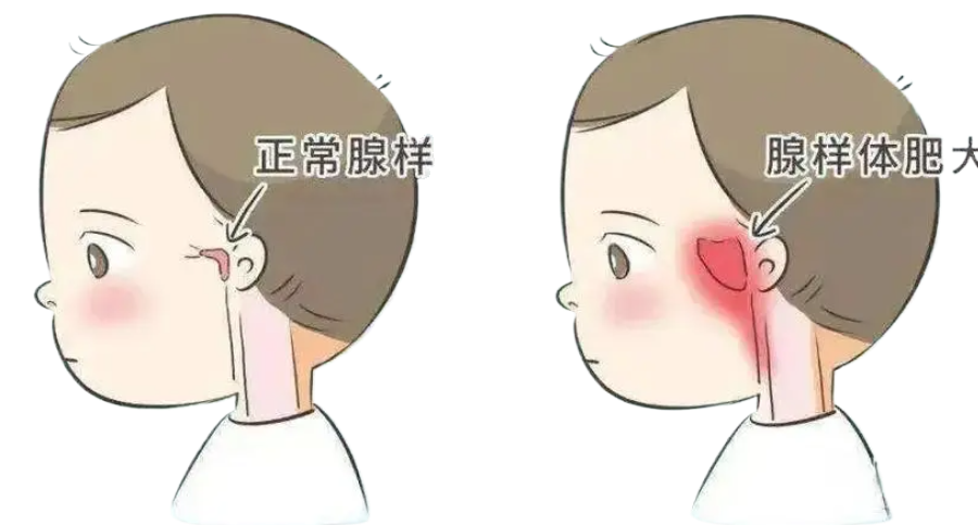 孩子腺樣體肥大影響發(fā)育和容貌，趁五一假期，微創(chuàng)治療快速治愈！(圖1)