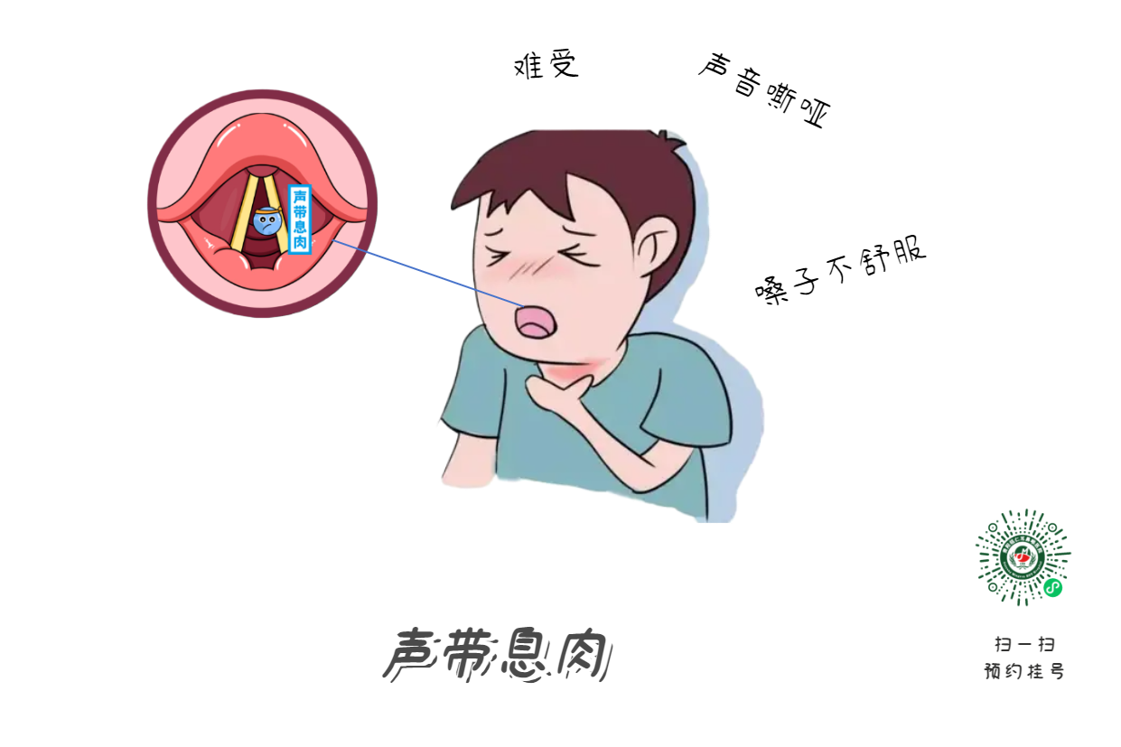 長期清嗓子？可能是聲帶息肉早期信號(圖1)