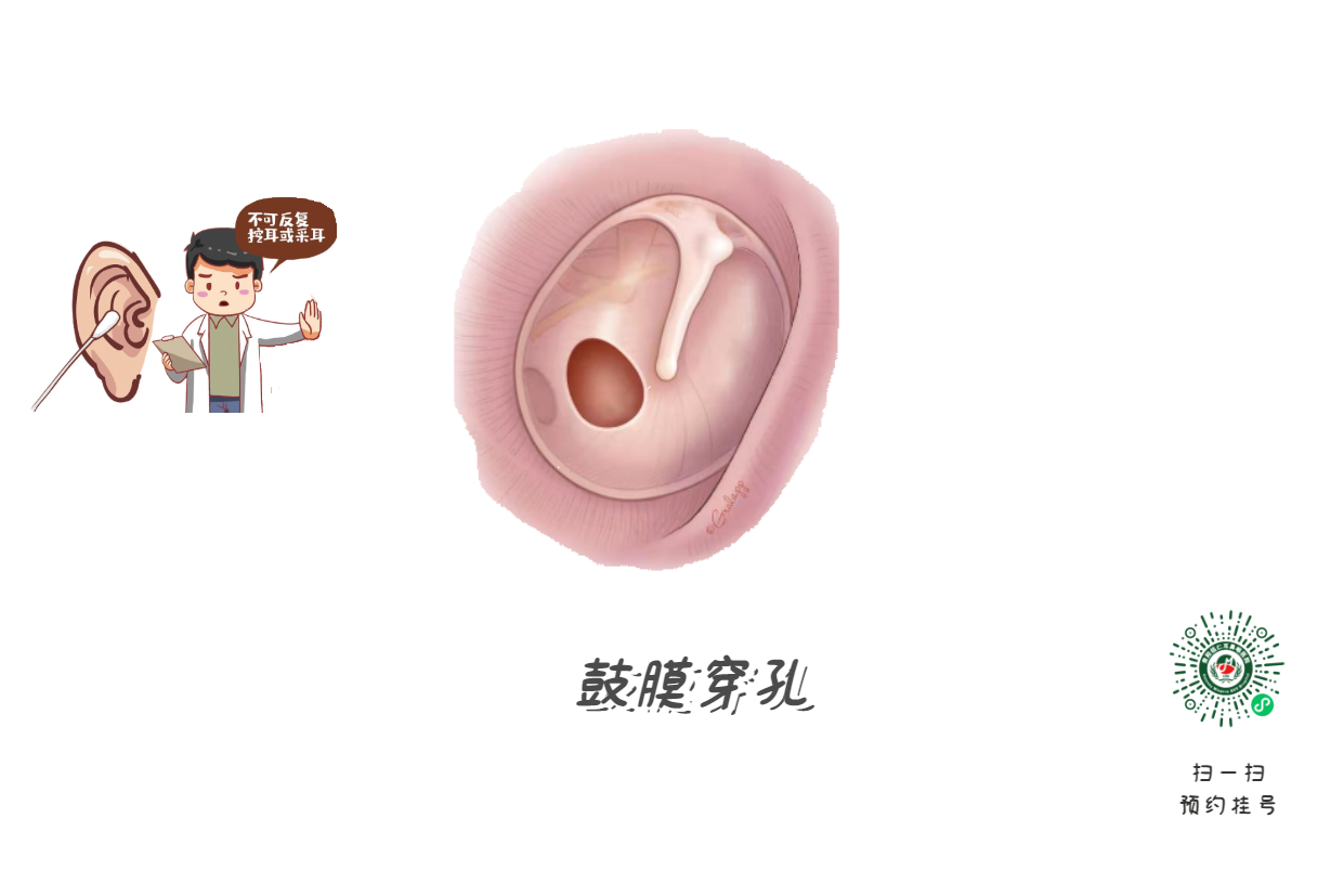 掏耳朵致鼓膜穿孔？這些動(dòng)作最危險(xiǎn)！(圖2)