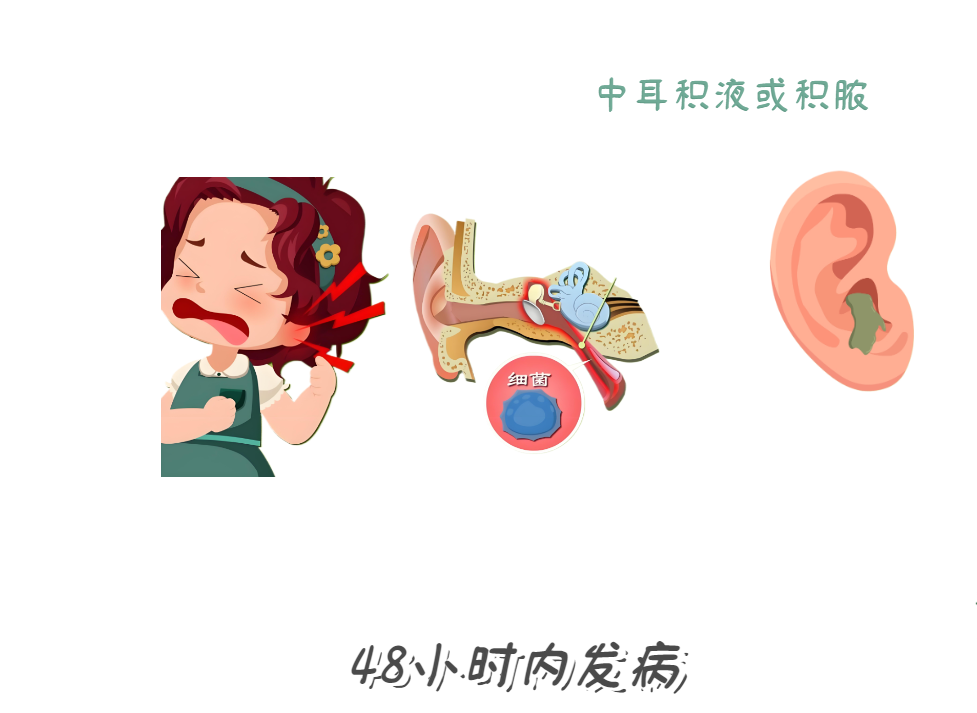 耳朵痛到睡不著？急性中耳炎急救法！(圖2)