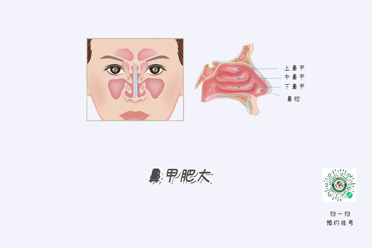 頭痛欲裂？可能是鼻竇炎在作祟！(圖2)