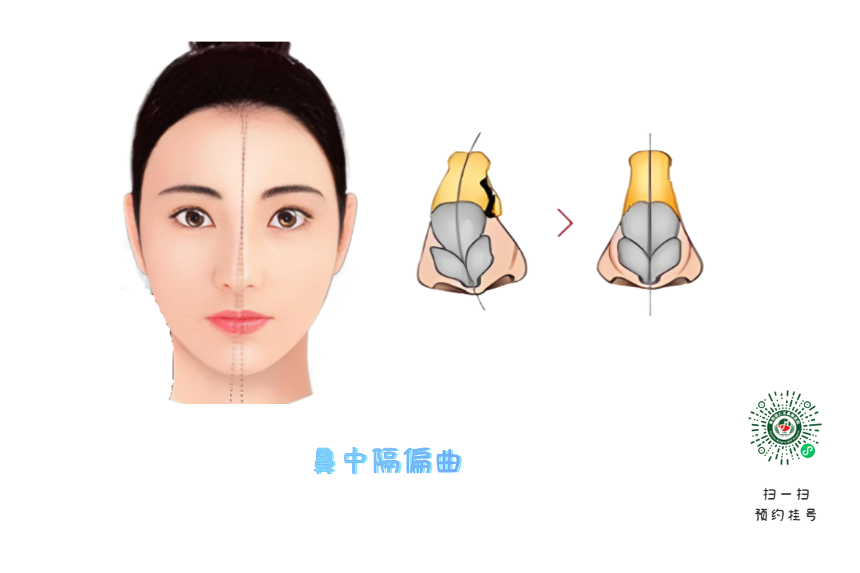 十年鼻塞不見好？問題可能出在“鼻梁歪了”！(圖1)